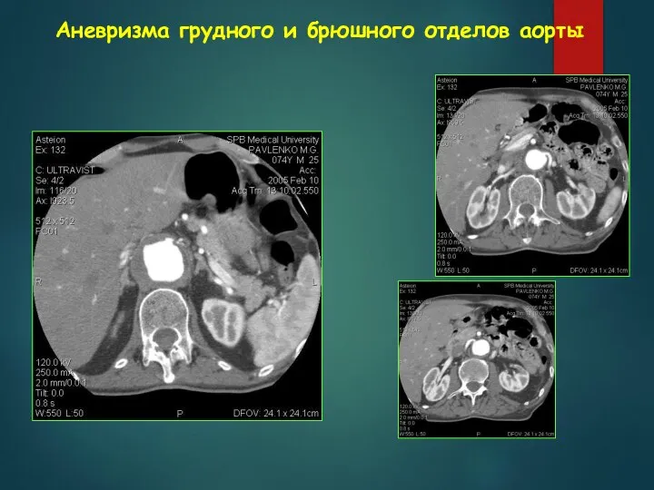 Аневризма грудного и брюшного отделов аорты