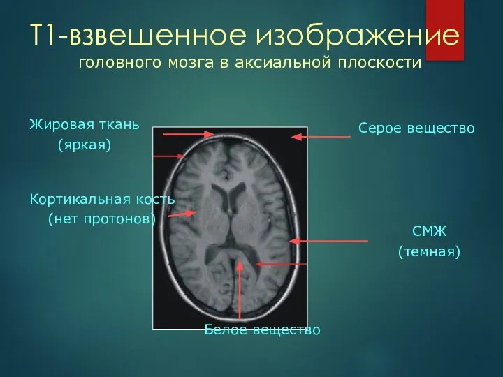 Т1-взвешенное изображение Жировая ткань (яркая) СМЖ (темная) Кортикальная кость (нет протонов) Серое