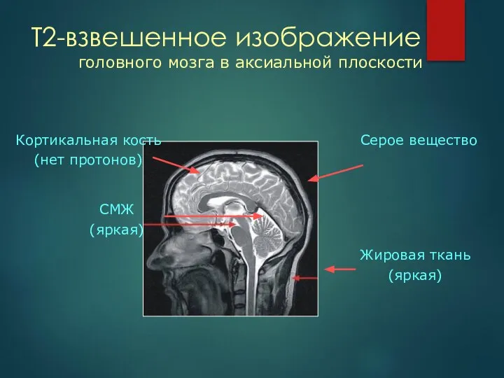 Т2-взвешенное изображение СМЖ (яркая) Жировая ткань (яркая) Кортикальная кость (нет протонов) Серое