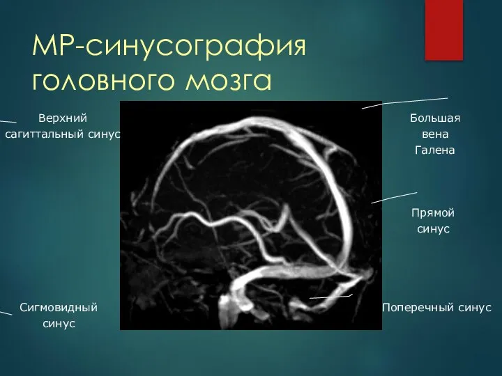 МР-синусография головного мозга Верхний сагиттальный синус Сигмовидный синус Поперечный синус Большая вена Галена Прямой синус