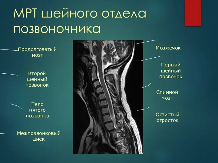 МРТ шейного отдела позвоночника Продолговатый мозг Спинной мозг Второй шейный позвонок Межпозвонковый