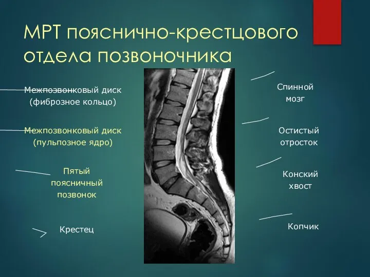 МРТ пояснично-крестцового отдела позвоночника Крестец Пятый поясничный позвонок Межпозвонковый диск (пульпозное ядро)