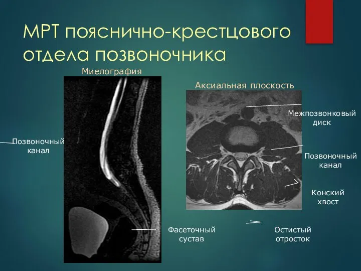 МРТ пояснично-крестцового отдела позвоночника Миелография Аксиальная плоскость Позвоночный канал Остистый отросток Фасеточный