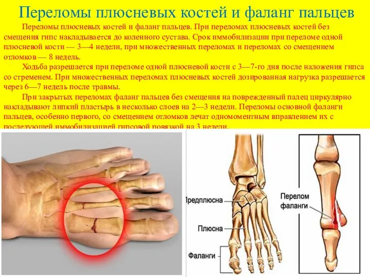 Переломы плюсневых костей и фаланг пальцев Переломы плюсневых костей и фаланг пальцев.