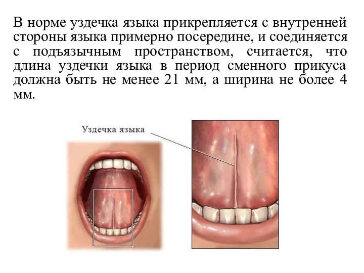 В норме уздечка языка прикрепляется с внутренней стороны языка примерно посередине, и