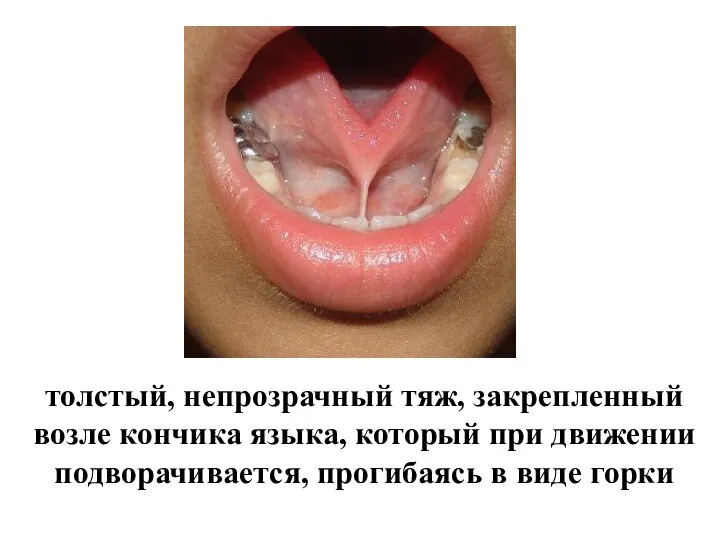 толстый, непрозрачный тяж, закрепленный возле кончика языка, который при движении подворачивается, прогибаясь в виде горки