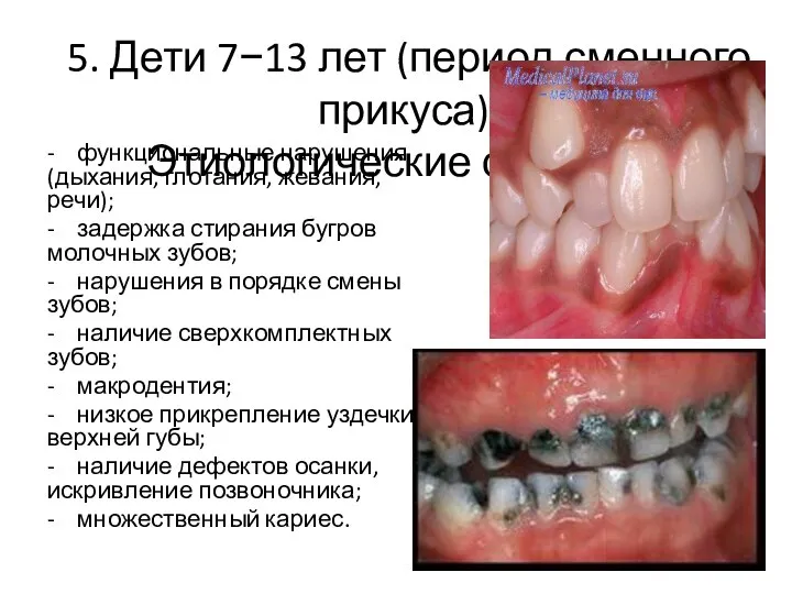 5. Дети 7−13 лет (период сменного прикуса). Этиологические факторы: - функциональные нарушения