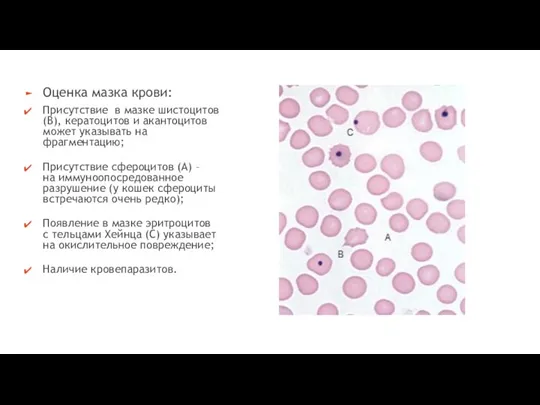 Оценка мазка крови: Присутствие в мазке шистоцитов (В), кератоцитов и акантоцитов может