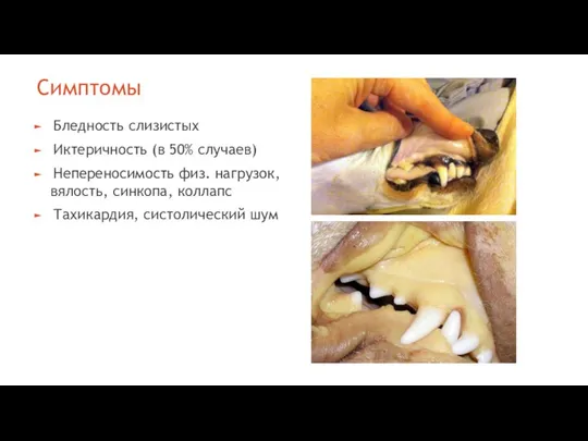 Симптомы Бледность слизистых Иктеричность (в 50% случаев) Непереносимость физ. нагрузок, вялость, синкопа, коллапс Тахикардия, систолический шум