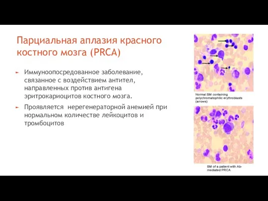 Парциальная аплазия красного костного мозга (PRCA) Иммуноопосредованное заболевание, связанное с воздействием антител,