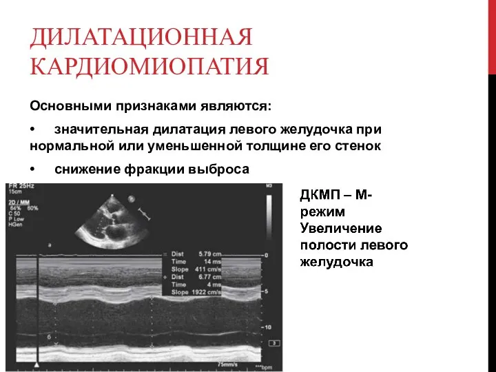 ДИЛАТАЦИОННАЯ КАРДИОМИОПАТИЯ Основными признаками являются: • значительная дилатация левого желудочка при нормальной