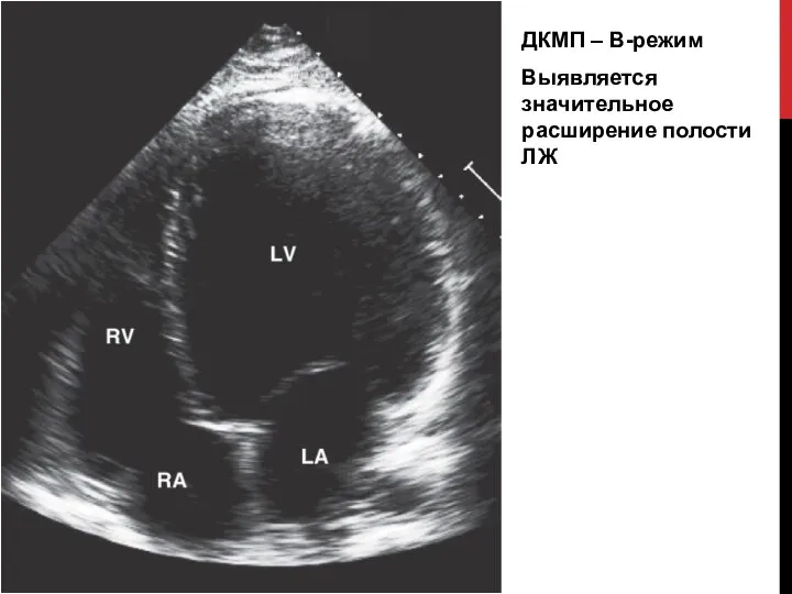 ДКМП – В-режим Выявляется значительное расширение полости ЛЖ