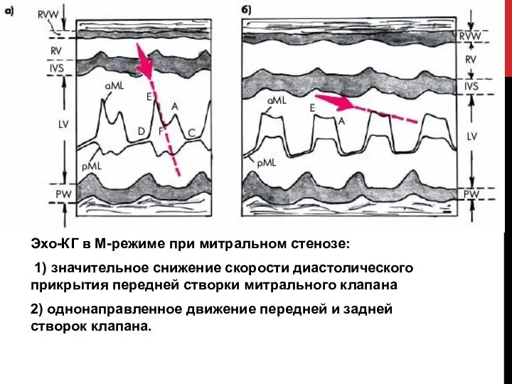 Эхо-КГ в М-режиме при митральном стенозе: 1) значительное снижение скорости диастолического прикрытия