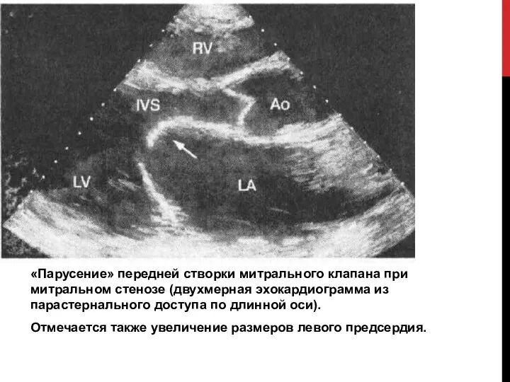 «Парусение» передней створки митрального клапана при митральном стенозе (двухмерная эхокардиограмма из парастернального