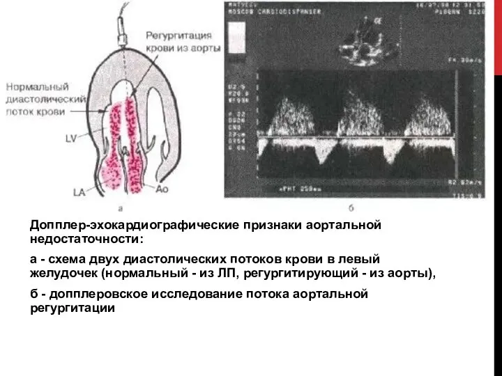 Допплер-эхокардиографические признаки аортальной недостаточности: а - схема двух диастолических потоков крови в