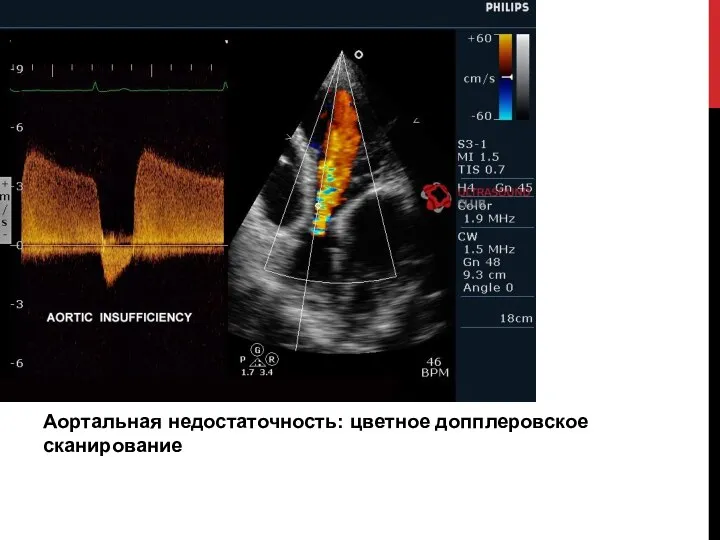 Аортальная недостаточность: цветное допплеровское сканирование