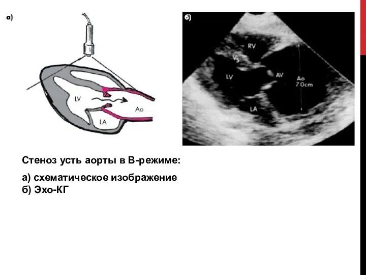 Стеноз усть аорты в В-режиме: а) схематическое изображение б) Эхо-КГ