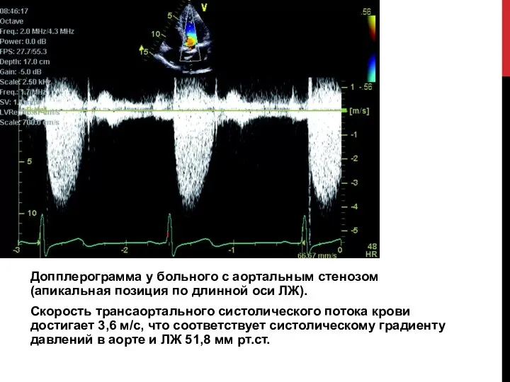 Допплерограмма у больного с аортальным стенозом (апикальная позиция по длинной оси ЛЖ).