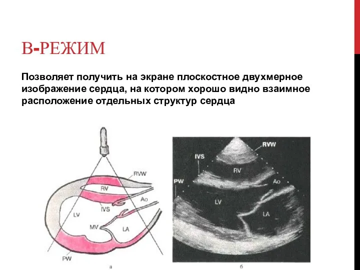 В-РЕЖИМ Позволяет получить на экране плоскостное двухмерное изображение сердца, на котором хорошо