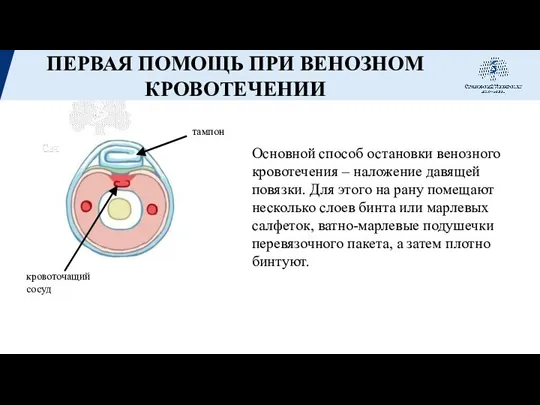 ПЕРВАЯ ПОМОЩЬ ПРИ ВЕНОЗНОМ КРОВОТЕЧЕНИИ Основной способ остановки венозного кровотечения – наложение