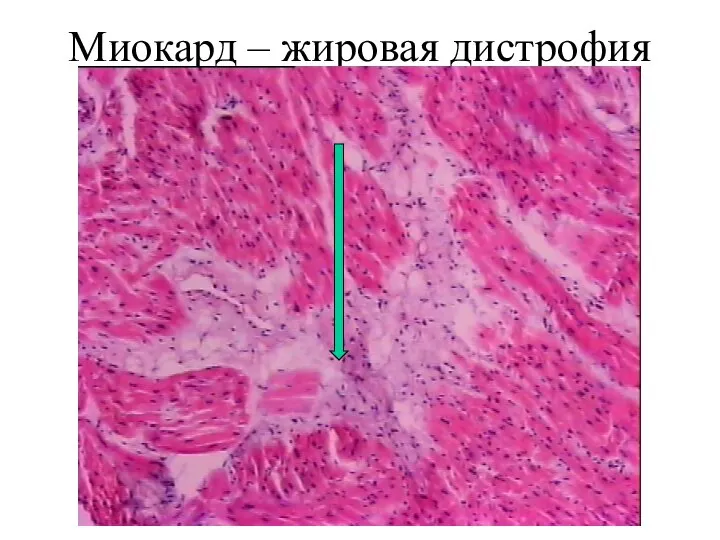 Миокард – жировая дистрофия