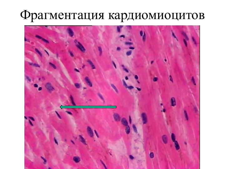 Фрагментация кардиомиоцитов