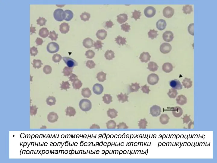 Стрелками отмечены ядросодержащие эритроциты; крупные голубые безъядерные клетки – ретикулоциты (полихроматофильные эритроциты)