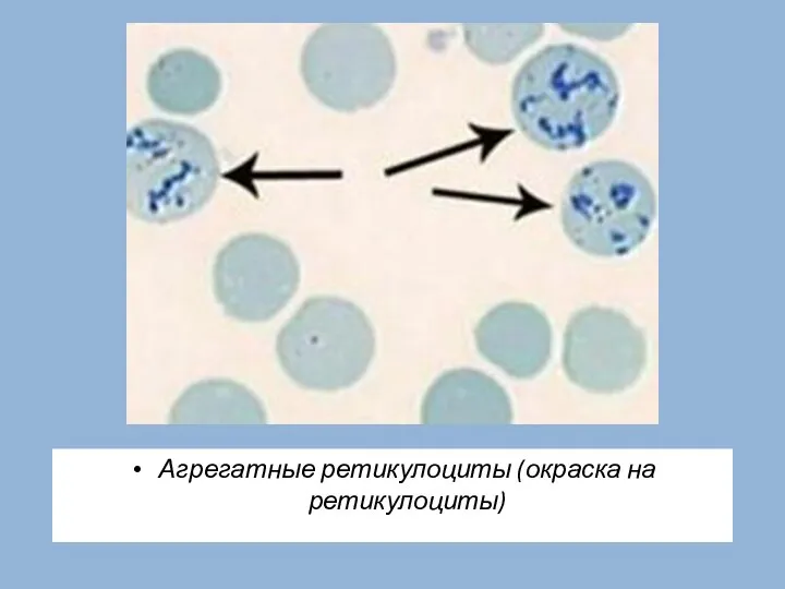 Агрегатные ретикулоциты (окраска на ретикулоциты)