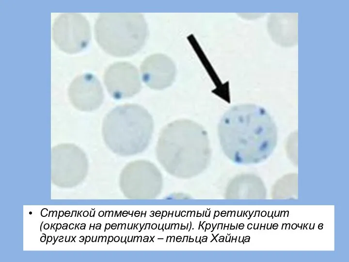 Стрелкой отмечен зернистый ретикулоцит (окраска на ретикулоциты). Крупные синие точки в других эритроцитах – тельца Хайнца