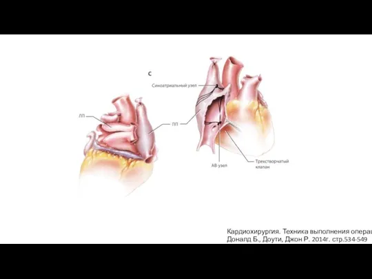 Кардиохирургия. Техника выполнения операций Доналд Б., Доути, Джон Р. 2014г. стр.534-549