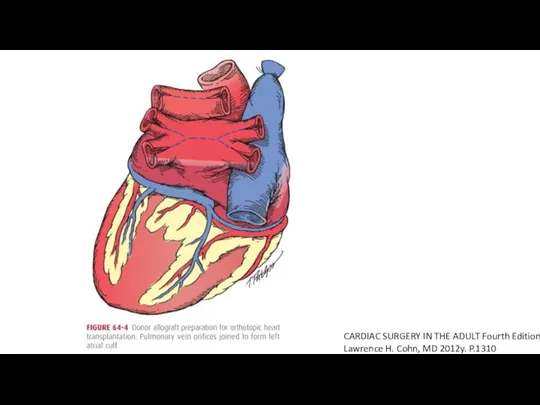 CARDIAC SURGERY IN THE ADULT Fourth Edition Lawrence H. Cohn, MD 2012y. P.1310