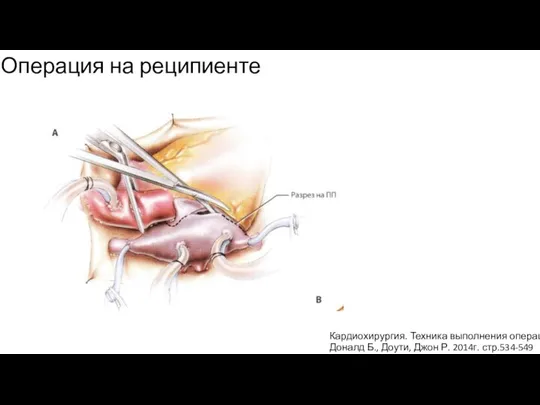 Операция на реципиенте Кардиохирургия. Техника выполнения операций Доналд Б., Доути, Джон Р. 2014г. стр.534-549