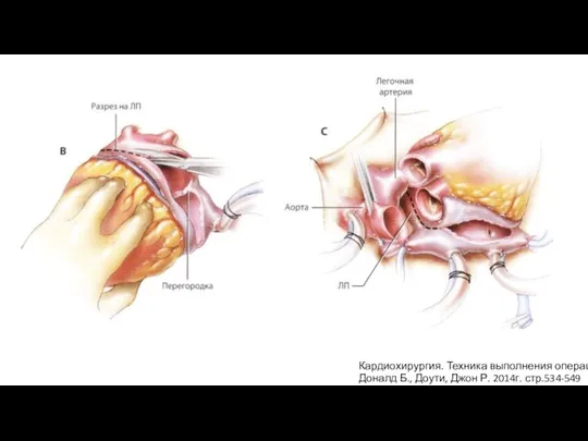 Кардиохирургия. Техника выполнения операций Доналд Б., Доути, Джон Р. 2014г. стр.534-549