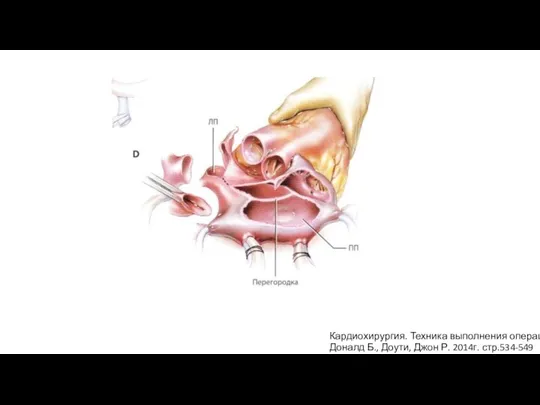 Кардиохирургия. Техника выполнения операций Доналд Б., Доути, Джон Р. 2014г. стр.534-549