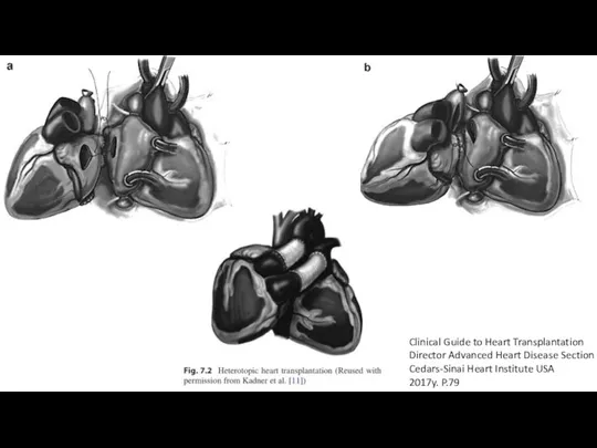 Clinical Guide to Heart Transplantation Director Advanced Heart Disease Section Cedars-Sinai Heart Institute USA 2017y. P.79