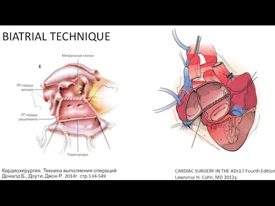 BIATRIAL TECHNIQUE Кардиохирургия. Техника выполнения операций Доналд Б., Доути, Джон Р. 2014г.