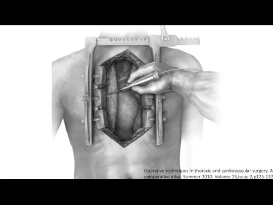 Operative techniques in thoracic and cardiovascular surgery. A comparative atlas. Summer 2010. Volume 15,issue 2,p125-137