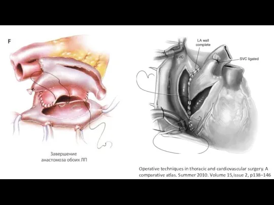 Operative techniques in thoracic and cardiovascular surgery. A comparative atlas. Summer 2010. Volume 15,issue 2, p138–146