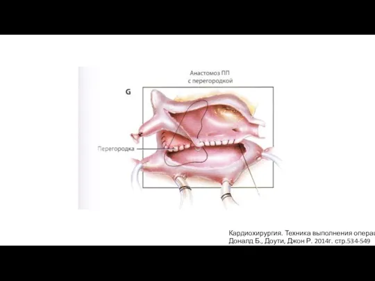Кардиохирургия. Техника выполнения операций Доналд Б., Доути, Джон Р. 2014г. стр.534-549