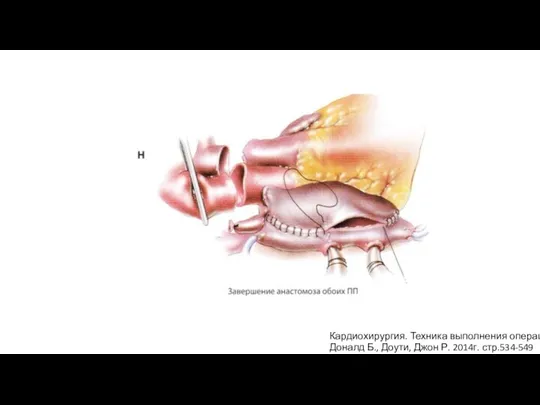 Кардиохирургия. Техника выполнения операций Доналд Б., Доути, Джон Р. 2014г. стр.534-549