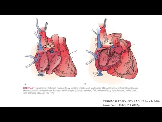 CARDIAC SURGERY IN THE ADULT Fourth Edition Lawrence H. Cohn, MD 2012y.