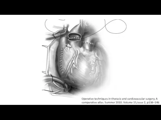 Operative techniques in thoracic and cardiovascular surgery. A comparative atlas. Summer 2010. Volume 15,issue 2, p138–146