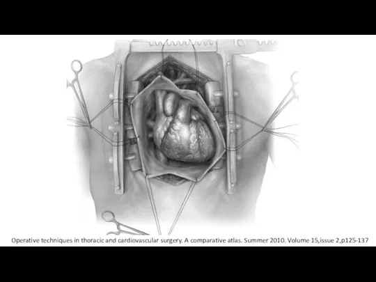 Operative techniques in thoracic and cardiovascular surgery. A comparative atlas. Summer 2010. Volume 15,issue 2,p125-137