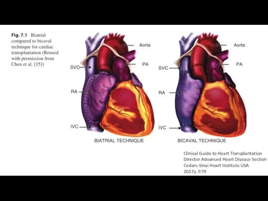 Clinical Guide to Heart Transplantation Director Advanced Heart Disease Section Cedars-Sinai Heart Institute USA 2017y. P.79