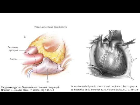 Operative techniques in thoracic and cardiovascular surgery. A comparative atlas. Summer 2010.