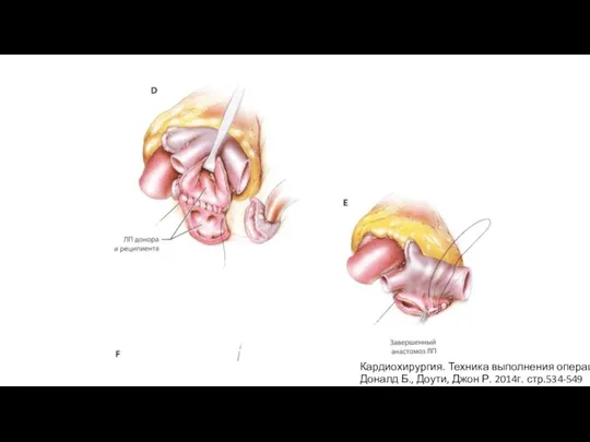 Кардиохирургия. Техника выполнения операций Доналд Б., Доути, Джон Р. 2014г. стр.534-549