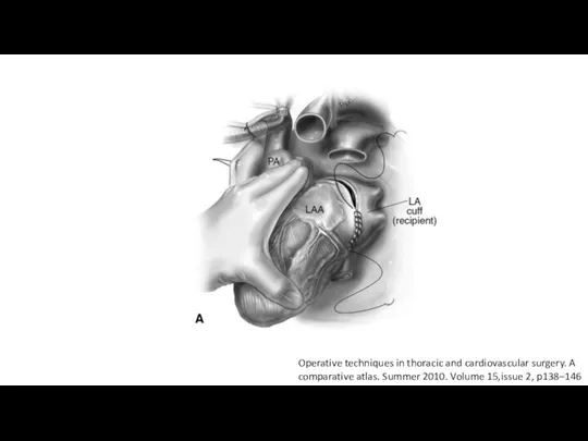 Operative techniques in thoracic and cardiovascular surgery. A comparative atlas. Summer 2010. Volume 15,issue 2, p138–146