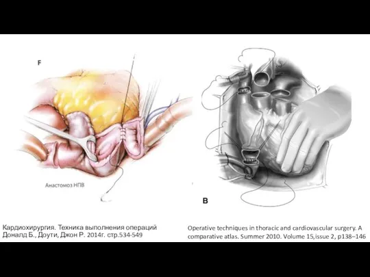 Operative techniques in thoracic and cardiovascular surgery. A comparative atlas. Summer 2010.