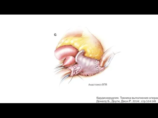 Кардиохирургия. Техника выполнения операций Доналд Б., Доути, Джон Р. 2014г. стр.534-549