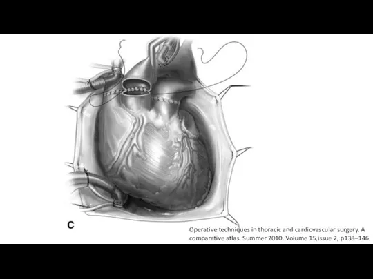 Operative techniques in thoracic and cardiovascular surgery. A comparative atlas. Summer 2010. Volume 15,issue 2, p138–146